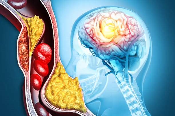Pengobatan Arteriosklerosis Cara Mengatasi Penyempitan Pembuluh Darah